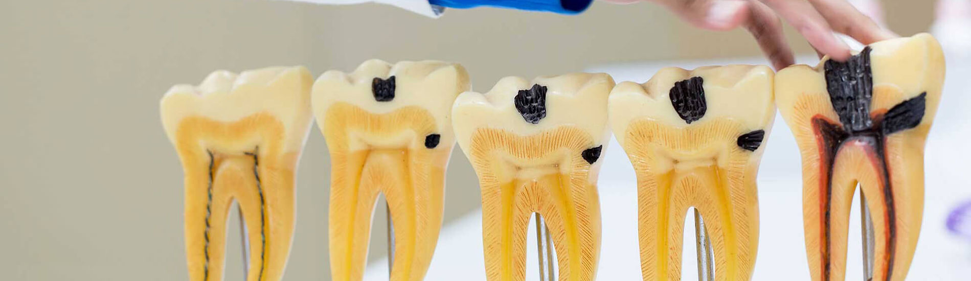 Root Canals